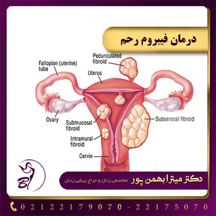 درمان فیبروم رحم